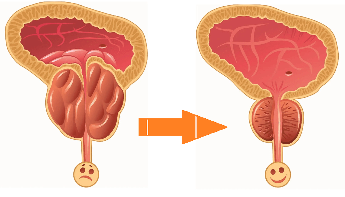 Wirkung von Uromexil Forte auf die Prostata bei Prostatitis und Adenom